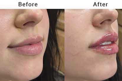 lip-filler-before-and-after