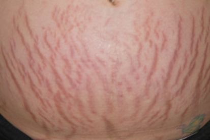 stretchmarks-on-stomach