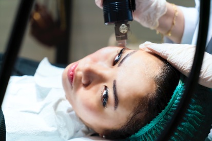 Microneedling-treatment