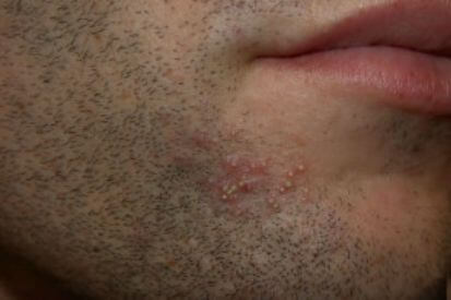 folliculitis-example