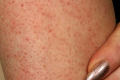 keratosis-pilaris-example