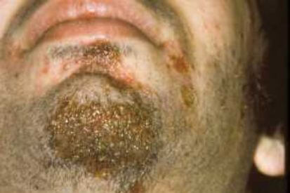 Impetigo-Example