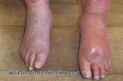 cellulitis-example