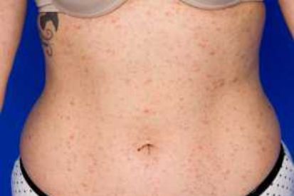 Pityriasis-Rosea-on-stomach