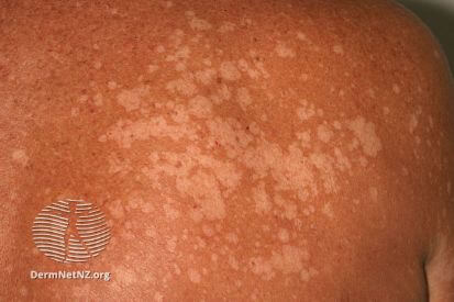 Tinea-Versicolor-example