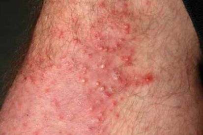 folliculitis-example