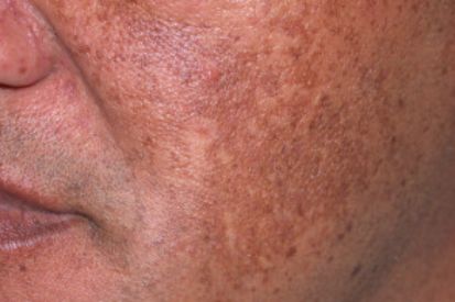 Melasma-example-on-cheeks