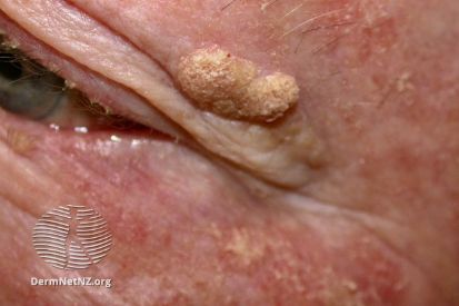 Seborrheic-Keratosis-example