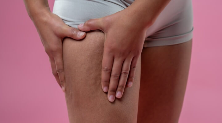 woman toiching cellulitis