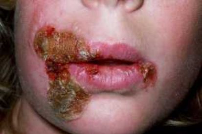 Impetigo-Example