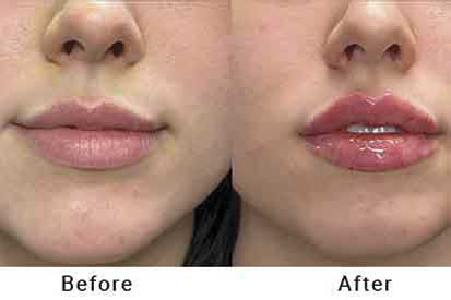 lip-filler-before-and-after