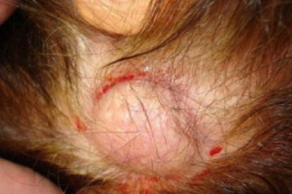 cyst-on-head