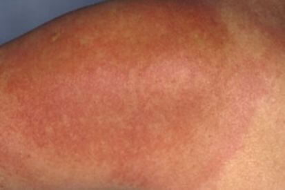 Lyme-Disease-rash