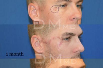 skin-cancer-removal-before-and-after-temple