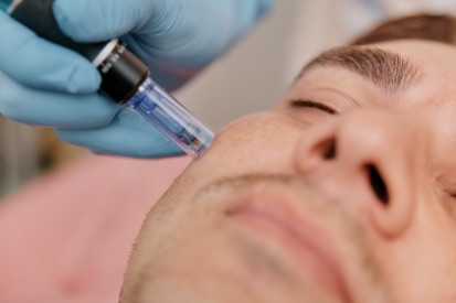 man-getting-Microneedling