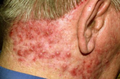 folliculitis-example