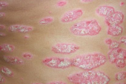 Psoriasis-example