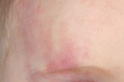 example-of-a-birthmark