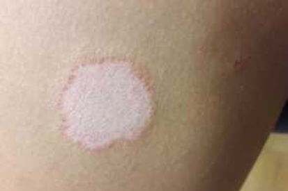 Pityriasis-Rosea-example