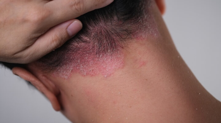 man with psoriasis