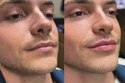 lip-filler-before-and-after