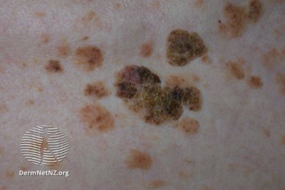 Seborrheic-Keratosis-example