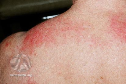 rash-on-shoulder