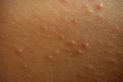 keratosis-pilaris-example