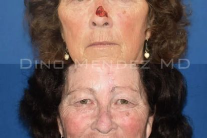 skin-cancer-removal-before-and-after-nose