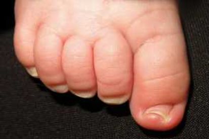 ingrown-toenaiail-example