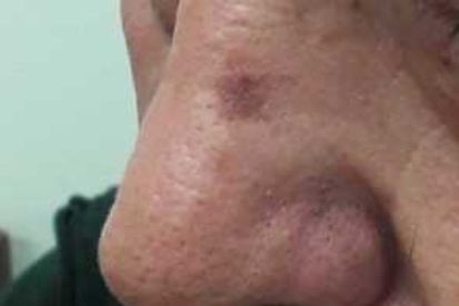 actinic-keratosis-on-nose