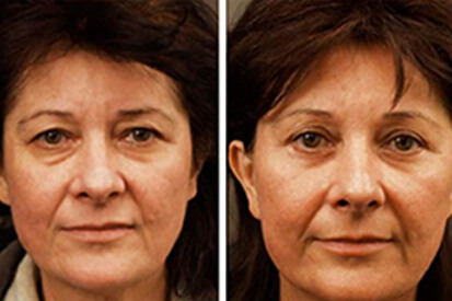 brow-lift-before-and-after