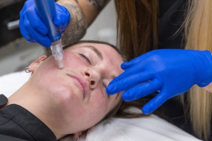 woman-getting-Microneedling