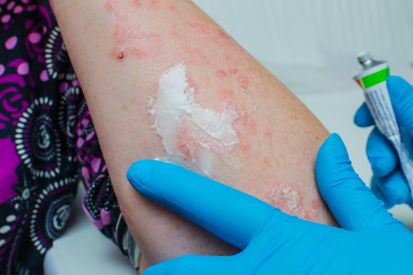 Psoriasis-cream