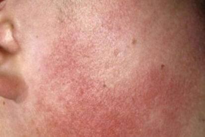 keratosis-pilaris-example