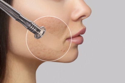 microdermabrasion-treatmnet-area