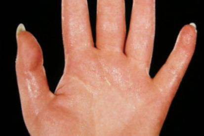 Hyperhidrosis-on-hand