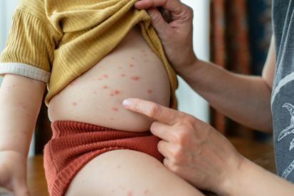 example-of-chicken-pox