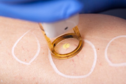 laser-vein-treatment