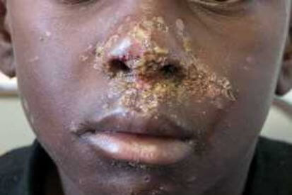 Impetigo-Example