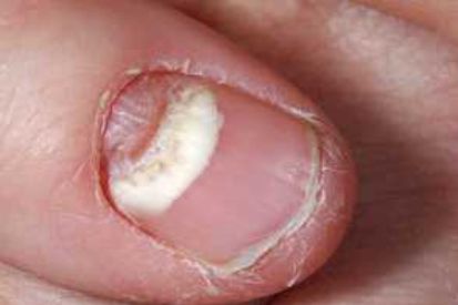 nail-fungus-example