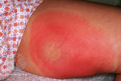 cellulitis-example