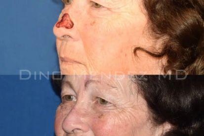 skin-cancer-removal-before-and-after-nose