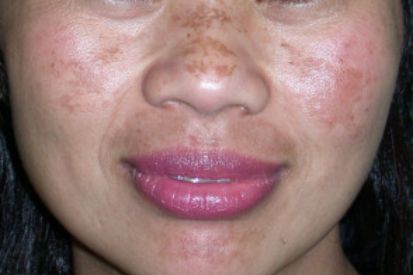 Melasma-example