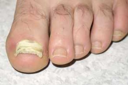 nail-fungus-example