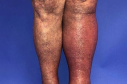 cellulitis-example