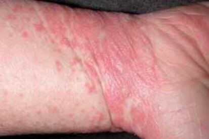 example-of-lichen-planus