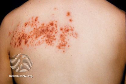 Shingles-example-on-back