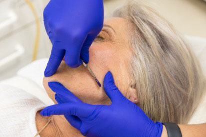 woman-getting-dermaplaning