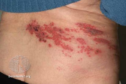 Shingles-example